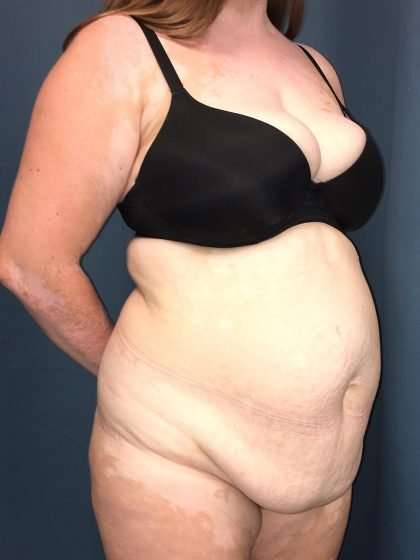 Tummy Tuck Before & After Patient #271