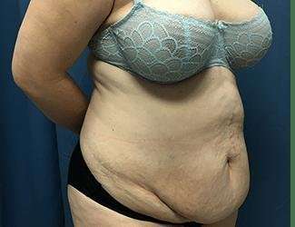 Tummy Tuck Before & After Patient #380