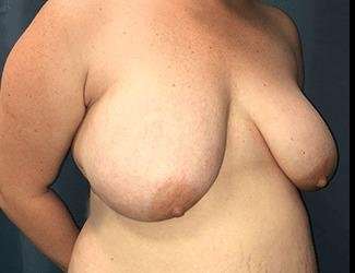 Breast Reduction Before & After Patient #1738