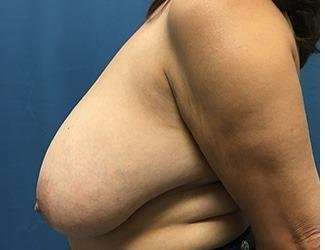 Breast Reduction Before & After Patient #1782