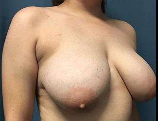 Breast Reduction Before & After Patient #1793