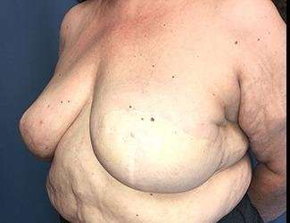 Breast Reduction Before & After Patient #1815