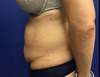 Tummy Tuck Before & After Patient #395