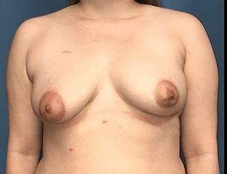 Breast Lift Before & After Patient #1903