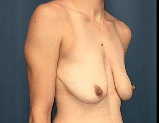 Breast Lift Before & After Patient #1923