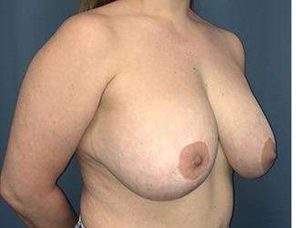 Breast Lift Before & After Patient #1945
