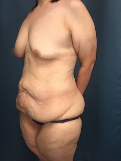 Tummy Tuck Before & After Patient #406