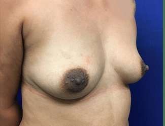 Breast Augmentation Before & After Patient #2080
