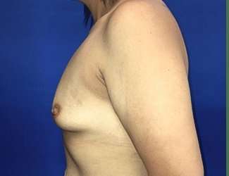 Breast Augmentation Before & After Patient #2091