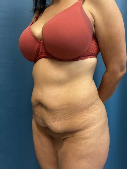 Tummy Tuck Before & After Patient #417
