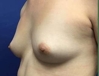 Breast Augmentation Before & After Patient #2102