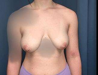 Breast Augmentation Before & After Patient #2111