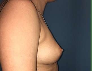Breast Augmentation Before & After Patient #2144
