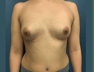 Breast Augmentation Before & After Patient #2153