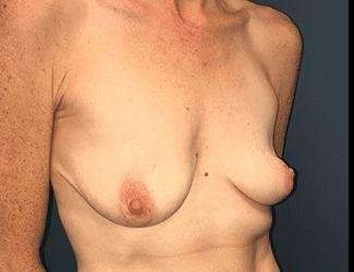 Breast Augmentation Before & After Patient #2162