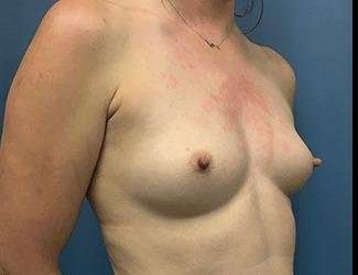 Breast Augmentation Before & After Patient #2191