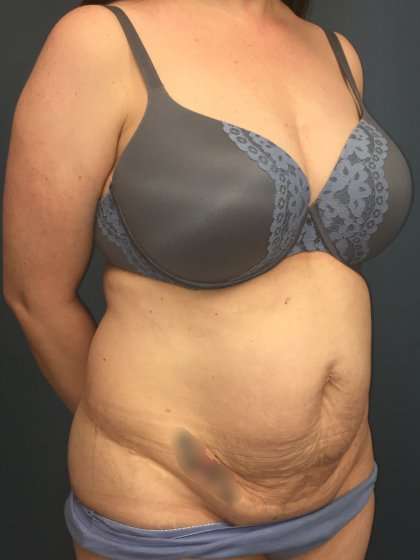 Tummy Tuck Before & After Patient #428