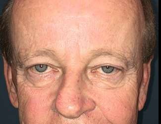 Blepharoplasty Before & After Patient #2251