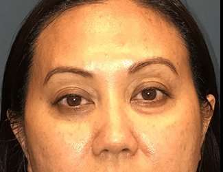 Blepharoplasty Before & After Patient #2260