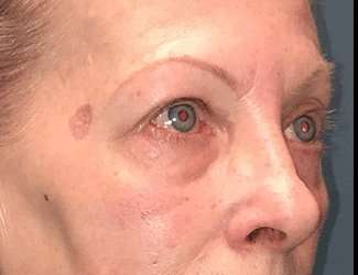 Blepharoplasty Before & After Patient #2271