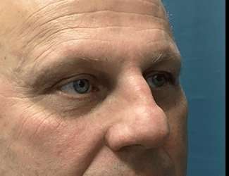 Blepharoplasty Before & After Patient #2282