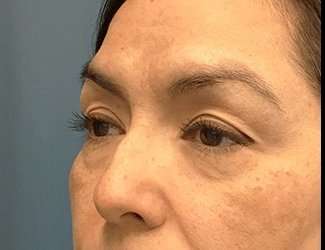 Blepharoplasty Before & After Patient #2293