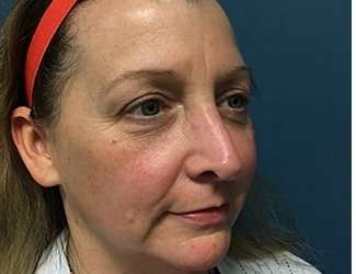 Blepharoplasty Before & After Patient #2308