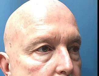 Blepharoplasty Before & After Patient #2328