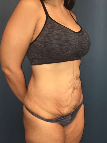 Tummy Tuck Before & After Patient #439
