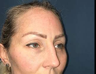 Blepharoplasty Before & After Patient #2339