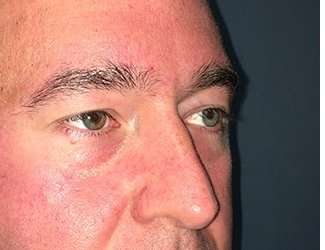 Blepharoplasty Before & After Patient #2352
