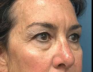Blepharoplasty Before & After Patient #2368