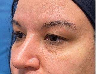 Blepharoplasty Before & After Patient #2385