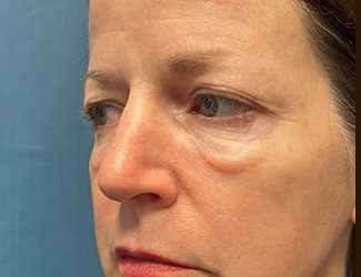 Blepharoplasty Before & After Patient #2408