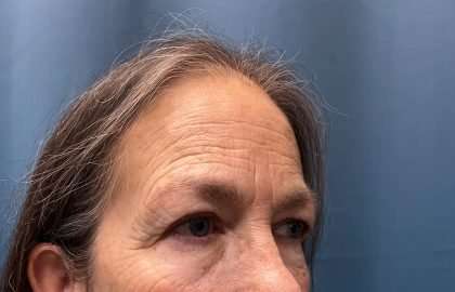 Blepharoplasty Before & After Patient #2419