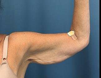 Arm Lift Before & After Patient #2461