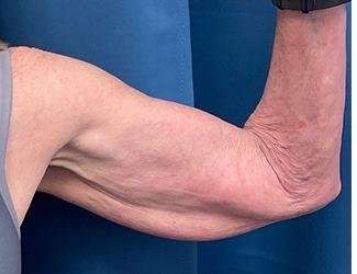 Arm Lift Before & After Patient #2473