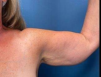 Arm Lift Before & After Patient #2482