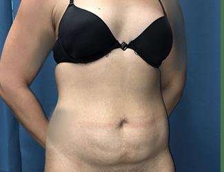 Tummy Tuck Before & After Patient #457