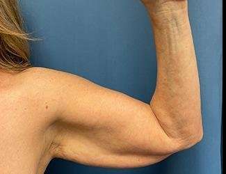 Arm Lift Before & After Patient #2491
