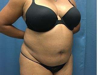 Tummy Tuck Before & After Patient #468