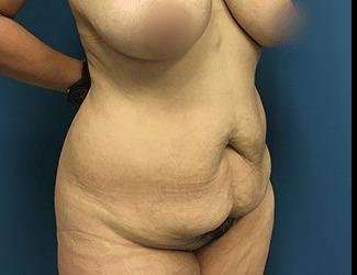 Tummy Tuck Before & After Patient #493