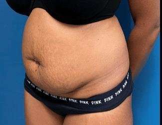 Tummy Tuck Before & After Patient #504