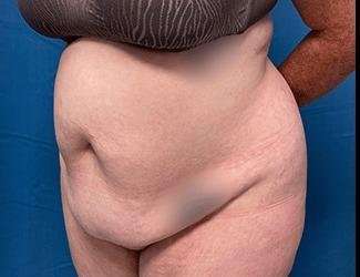 Tummy Tuck Before & After Patient #515