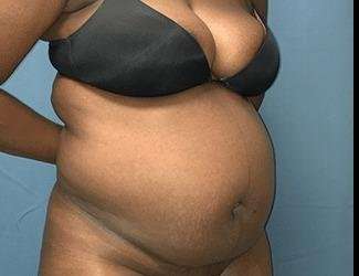 Tummy Tuck Before & After Patient #528