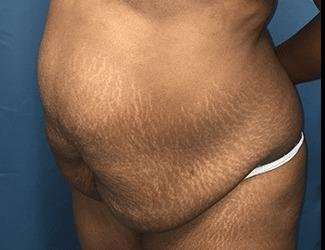 Tummy Tuck Before & After Patient #546
