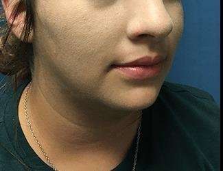 Submentoplasty Before & After Patient #610