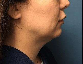 Submentoplasty Before & After Patient #621