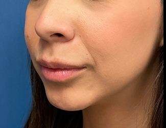 Submentoplasty Before & After Patient #632