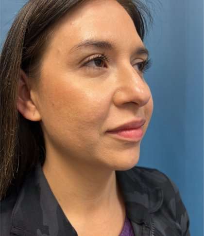 Submentoplasty Before & After Patient #643